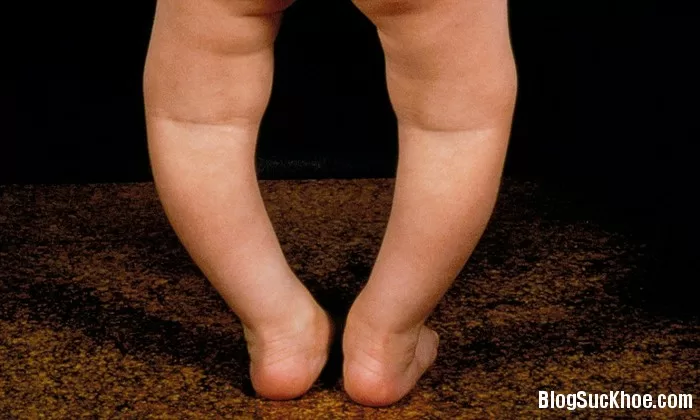 Bí quyết để bé không bị chân vòng kiềng