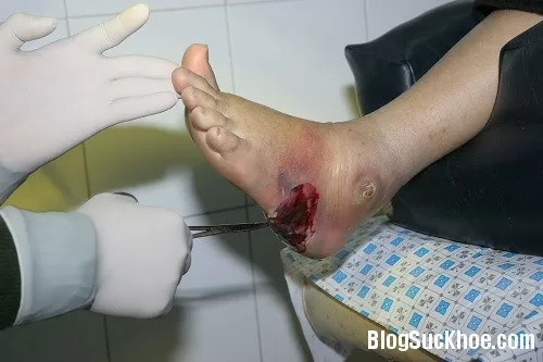 Biểu hiện và điều trị áp-xe cơ