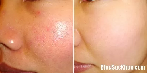 Cách chữa viêm lỗ chân lông tại nhà