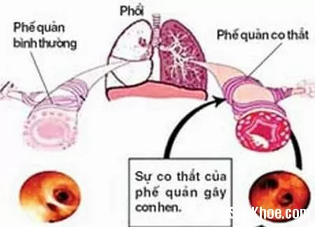 Các loại thuốc giãn phế quản