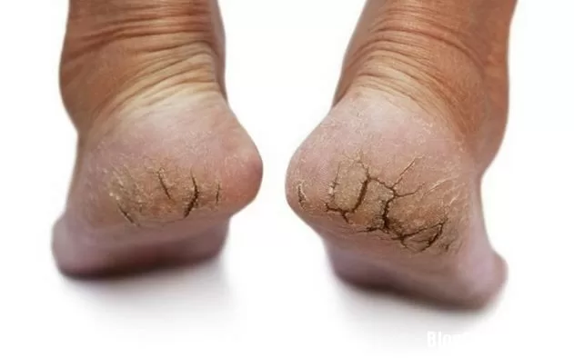 Trị nứt gót chân đơn giản tại nhà