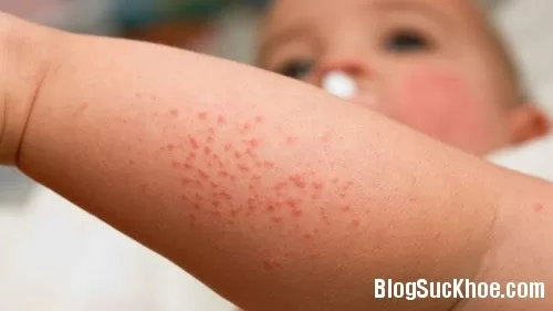 Phương pháp điều trị bệnh ban đỏ