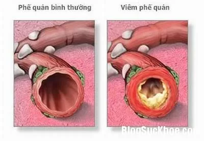 Thời gian điều trị viêm phế quản cấp