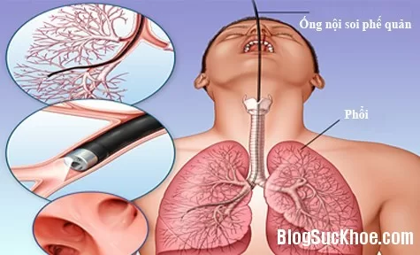 Soi phế quản là gì?