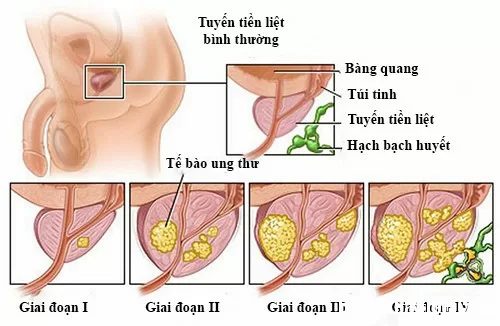 Dấu hiệu nhận biết ung thư tuyến tiền liệt
