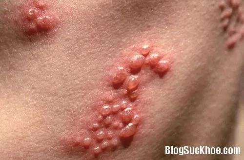Cảnh báo bệnh tình dục nguy hiểm qua ba loại mụn trên da