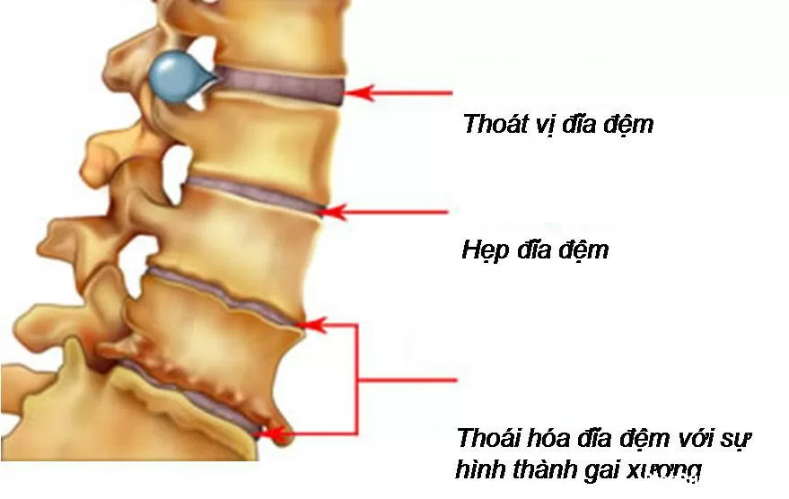 Sự hình thành gai cột sống