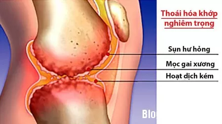 Bệnh thoái hóa khớp