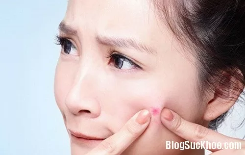 Nguyên nhân khiến mụn mãi không khỏi