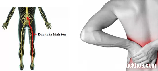 Các dấu hiệu đau dây thần kinh tọa