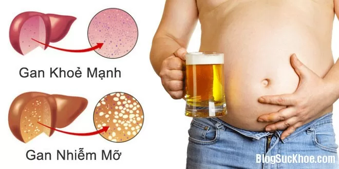 Bài thuốc dân gian trị gan nhiễm mỡ