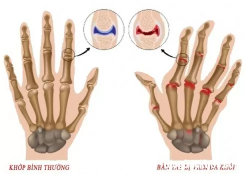 Nguyên liệu nhà bếp chữa dứt viêm khớp và đau dạ dày