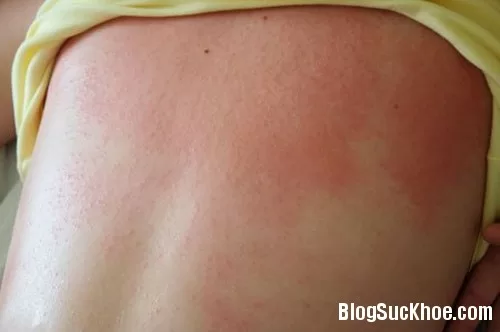 Những loại bệnh nguy hiểm khi đi bơi