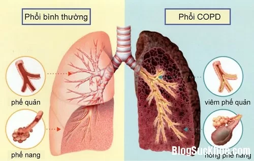 Thuốc chữa bệnh phổi tắc nghẽn mạn tính