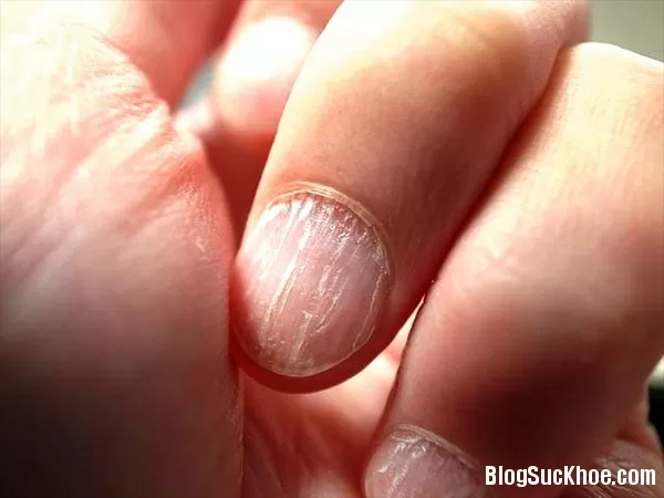 Màu sắc móng tiết lộ bệnh tật