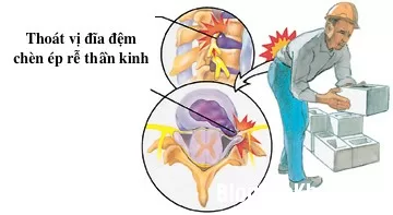 Cách chữa đau lưng