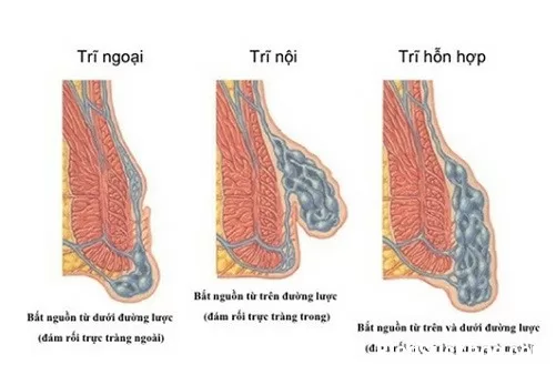 Nguyên tắc điều trị trĩ ngoại