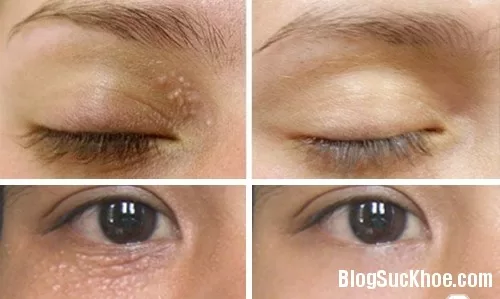 Tự chữa mụn thịt bằng phương pháp đơn giản trong dân gian