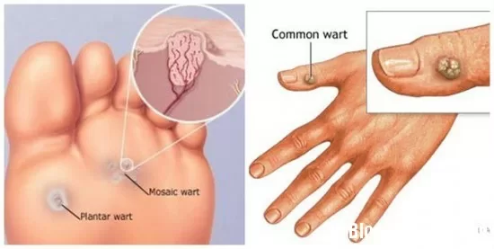 Những điều cần biết về mụn cóc lòng bàn chân