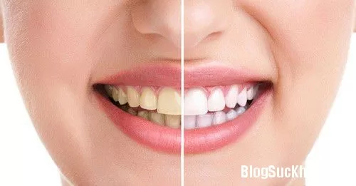 Bí quyết làm sạch bong cao răng