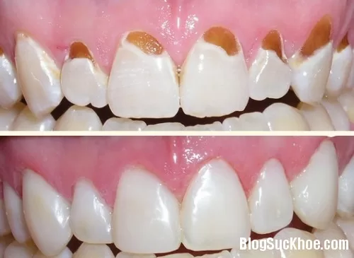 Hết hôi miệng, mảng bám răng chỉ sau 5 phút