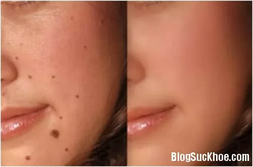Tự tẩy nốt ruồi tại nhà an toàn với muối