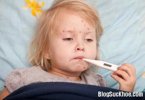 Những điều cần biết khi bị thủy đậu