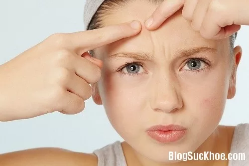 4 điều nên tránh để hết mụn trứng cá
