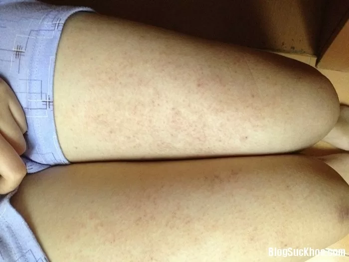 Cách đơn giản trị dứt điểm viêm lỗ chân lông