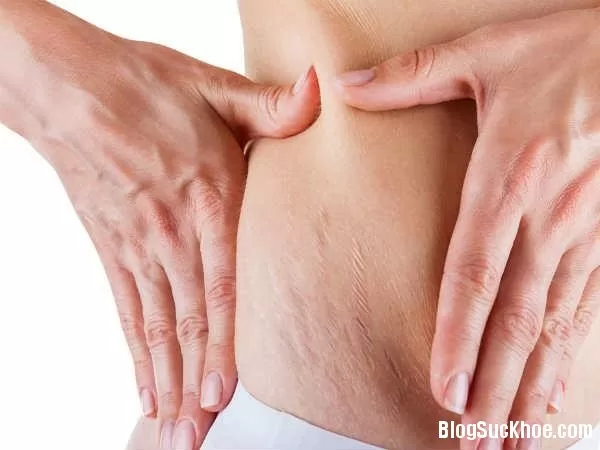 Mách mẹ một số mẹo trị rạn da sau sinh