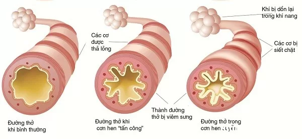 Phòng hen suyễn ở trẻ nhỏ