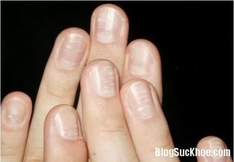 Đốm trắng trên móng tay nói lên bệnh gì?