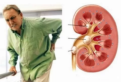 Chữa bệnh sỏi thận bằng nước ép rẻ tiền