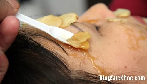 Công thức tự chế tại nhà trị sẹo hiệu quả