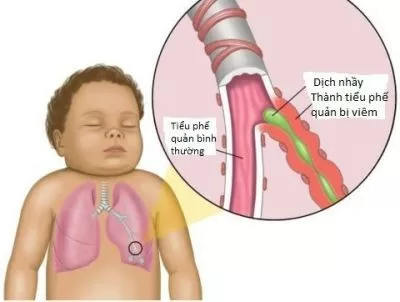 Nguyên nhân và biểu hiện bệnh viêm tiểu phế quản ở trẻ