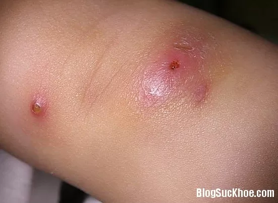 Điều trị mụn bằng bí quyết trong dân gian