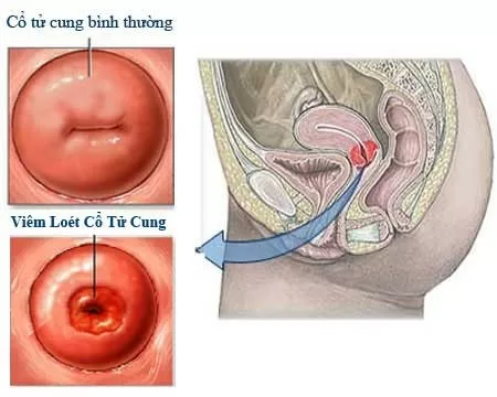 Biểu hiện viêm cổ tử cung