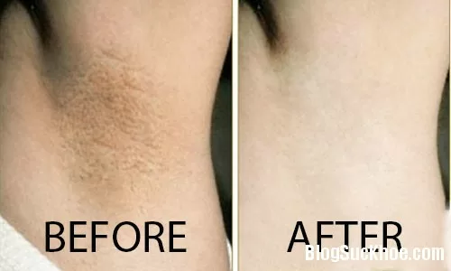 Khỏi lo thâm nách trong ngày hè oi bức
