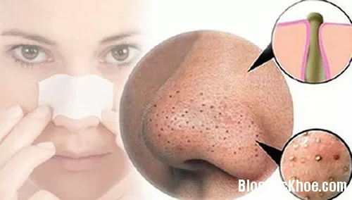 Mẹo đơn giản hút sạch mụn đầu đen