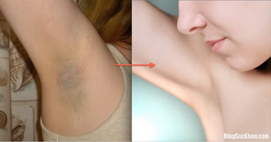 Điều trị thâm nách tại nhà bằng những mẹo đơn giản