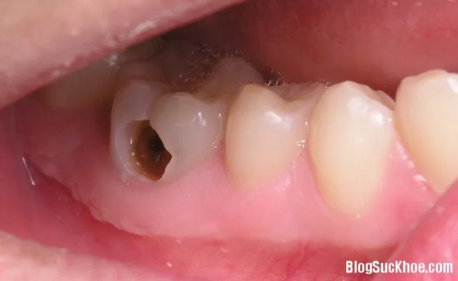 Mẹo dân gian chữa sâu răng hiệu quả