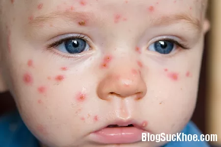 6 loại thực phẩm người bệnh thủy đậu nên tránh tuyệt đối