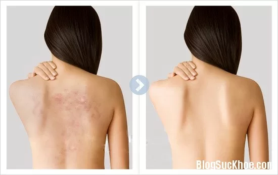 Diệt mụn ở lưng hiệu quả với rau mồng tơi