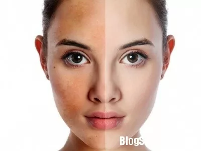 Mẹo giúp bạn phòng ngừa nám hiệu quả