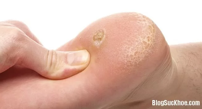 7 loại mụn cóc thường gặp