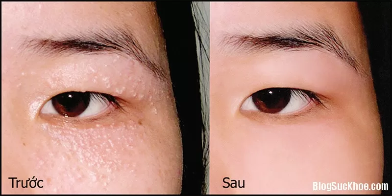 Tự chữa mụn thịt bằng phương pháp dân gian đơn giản