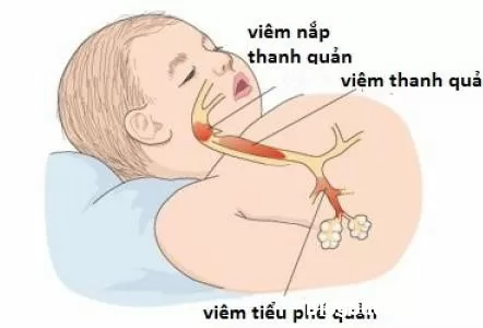 Nguyên nhân và biểu hiện khi trẻ bị viêm tiểu phế quản