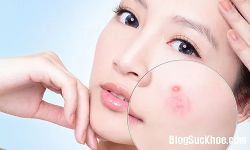 Công thức trị sạch mụn trứng cá