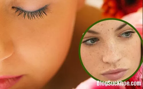 Đảm bảo hiệu quả với công thức chữa nám từ củ nghệ