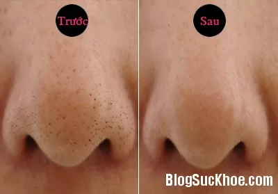 Hỗn hợp bôi lên mặt hút sạch mụn đầu đen